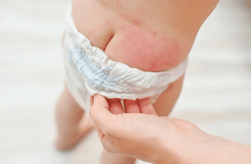 Nappy Rash Treatments